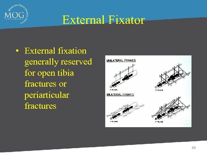 External Fixator • External fixation generally reserved for open tibia fractures or periarticular fractures