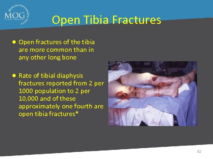 Open Tibia Fractures ● Open fractures of the tibia are more common than in