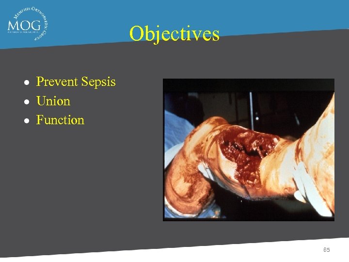 Objectives Prevent Sepsis ● Union ● Function ● 65 