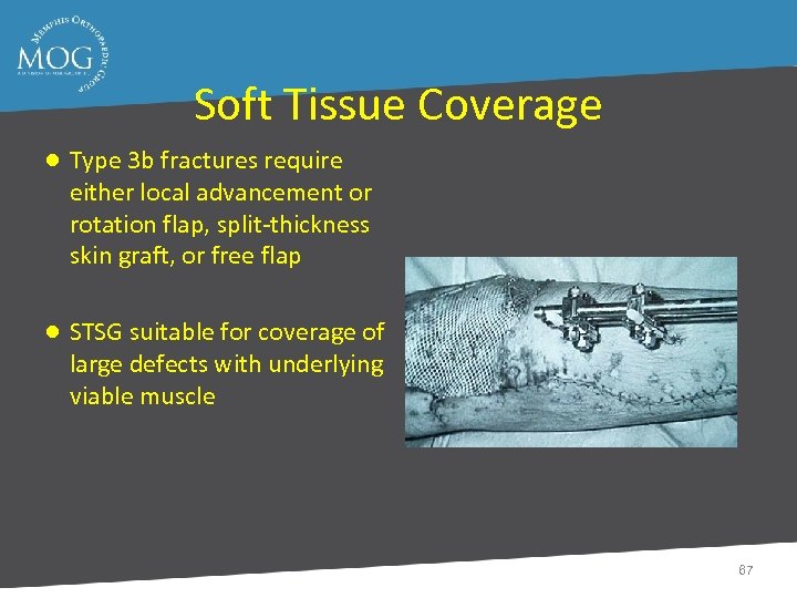 Soft Tissue Coverage ● Type 3 b fractures require either local advancement or rotation