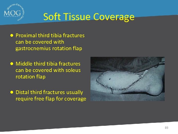 Soft Tissue Coverage ● Proximal third tibia fractures can be covered with gastrocnemius rotation