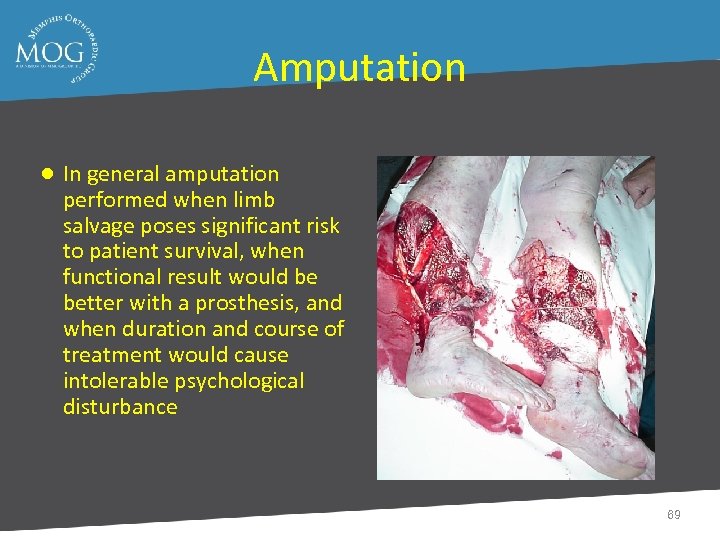 Amputation ● In general amputation performed when limb salvage poses significant risk to patient