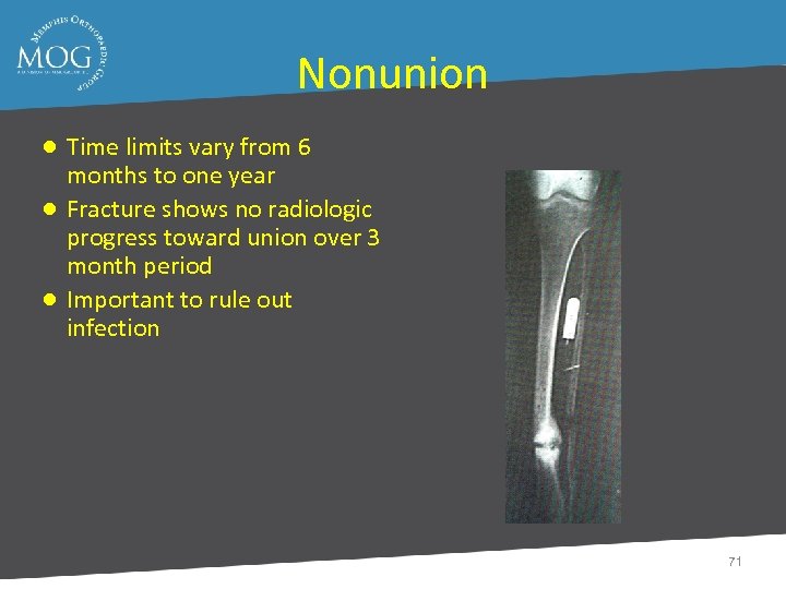 Nonunion ● Time limits vary from 6 months to one year ● Fracture shows