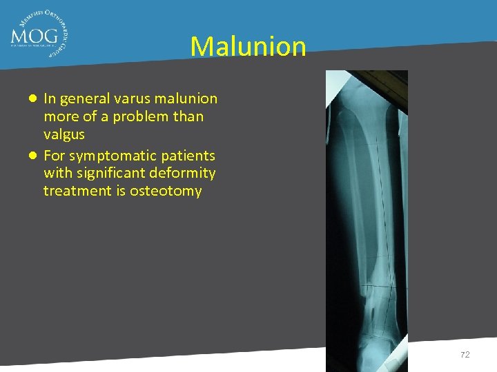 Malunion ● In general varus malunion more of a problem than valgus ● For