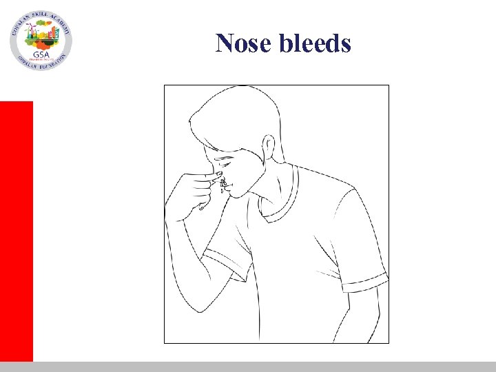 Nose bleeds 
