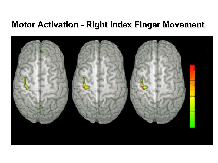 Motor Activation - Right Index Finger Movement % 100 75 5 0 25 1