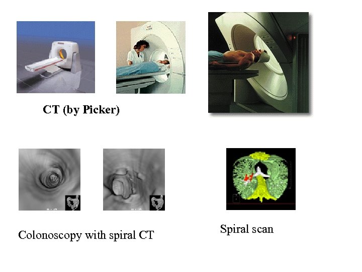 CT (by Picker) Colonoscopy with spiral CT Spiral scan 