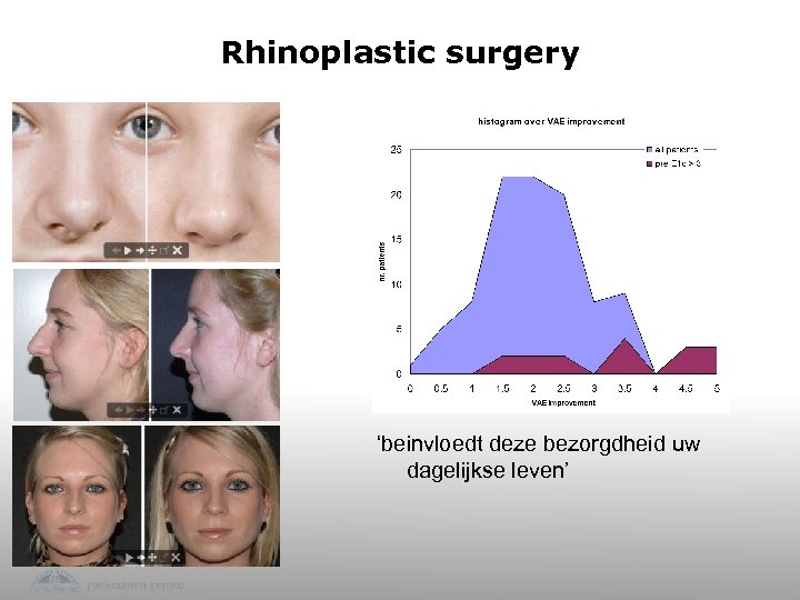 Rhinoplastic surgery ‘beinvloedt deze bezorgdheid uw dagelijkse leven’ 