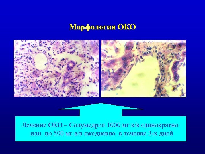 Морфология ОКО Лечение ОКО – Солумедрол 1000 мг в/в единократно или по 500 мг