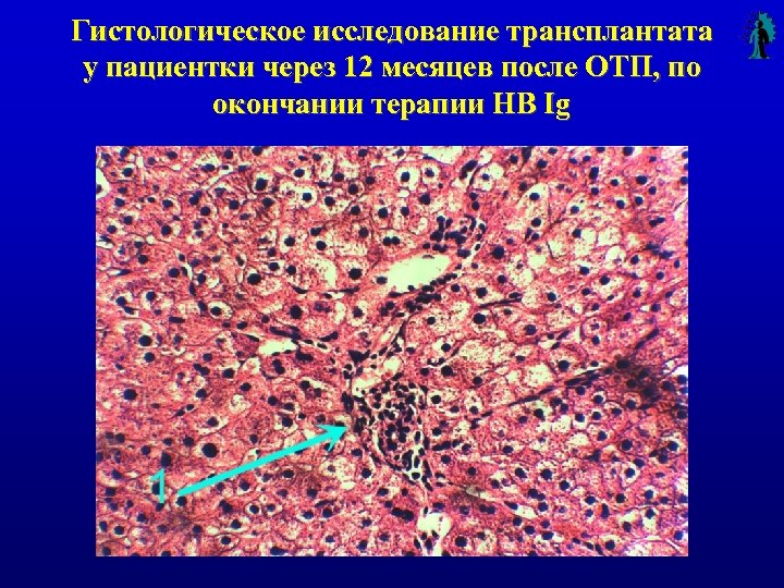 Гистологическое исследование трансплантата у пациентки через 12 месяцев после ОТП, по окончании терапии HB