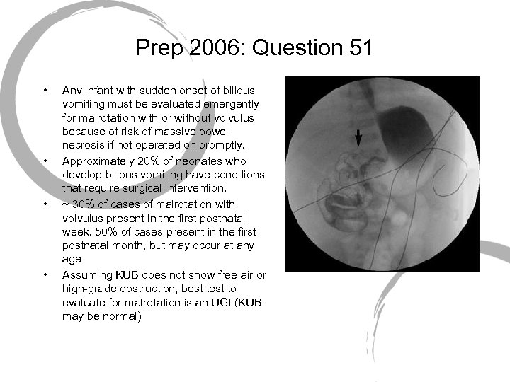 Prep 2006: Question 51 • • Any infant with sudden onset of bilious vomiting