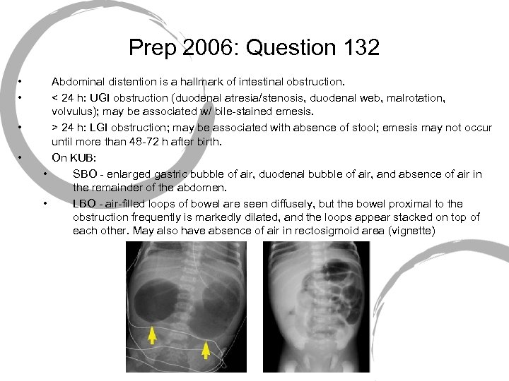 Prep 2006: Question 132 • • Abdominal distention is a hallmark of intestinal obstruction.