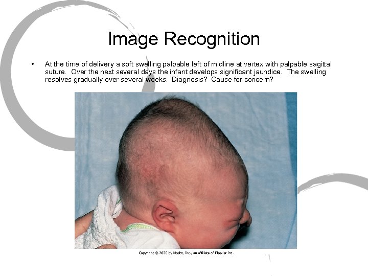Image Recognition • At the time of delivery a soft swelling palpable left of