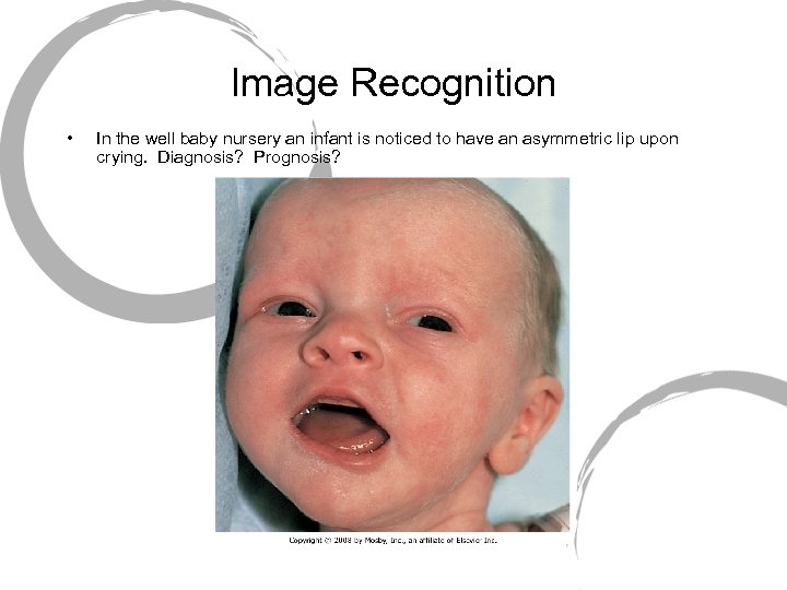 Image Recognition • In the well baby nursery an infant is noticed to have