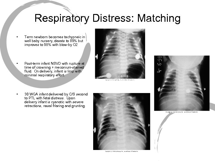 Respiratory Distress: Matching • Term newborn becomes tachypneic in well baby nursery, desats to