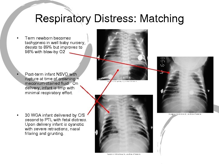 Respiratory Distress: Matching • Term newborn becomes tachypneic in well baby nursery, desats to
