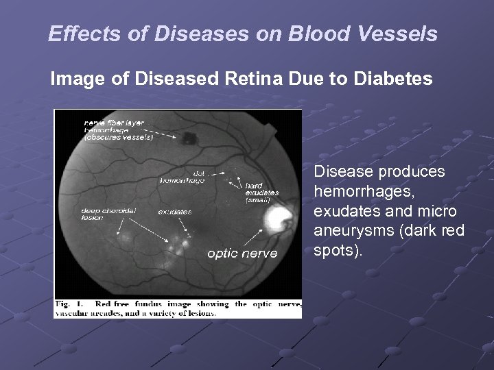 Effects of Diseases on Blood Vessels Image of Diseased Retina Due to Diabetes Disease