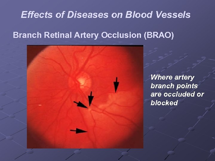 Effects of Diseases on Blood Vessels Branch Retinal Artery Occlusion (BRAO) Where artery branch