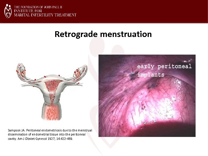 Retrograde menstruation Sampson JA. Peritoneal endometriosis due to the menstrual dissemination of endometrial tissue