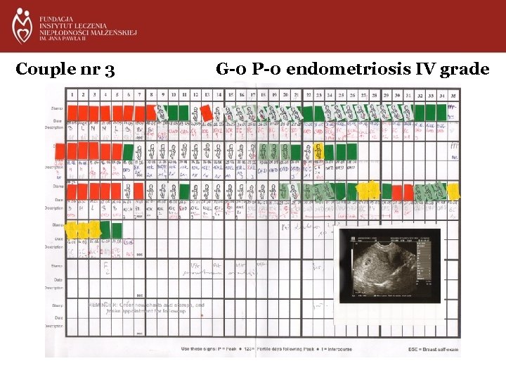 Couple nr 3 G-0 P-0 endometriosis IV grade 