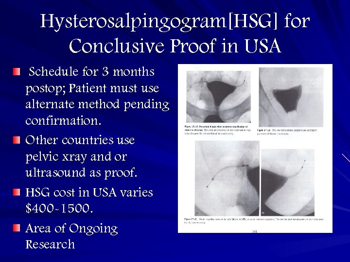 Hysterosalpingogram[HSG] for Conclusive Proof in USA Schedule for 3 months postop; Patient must use