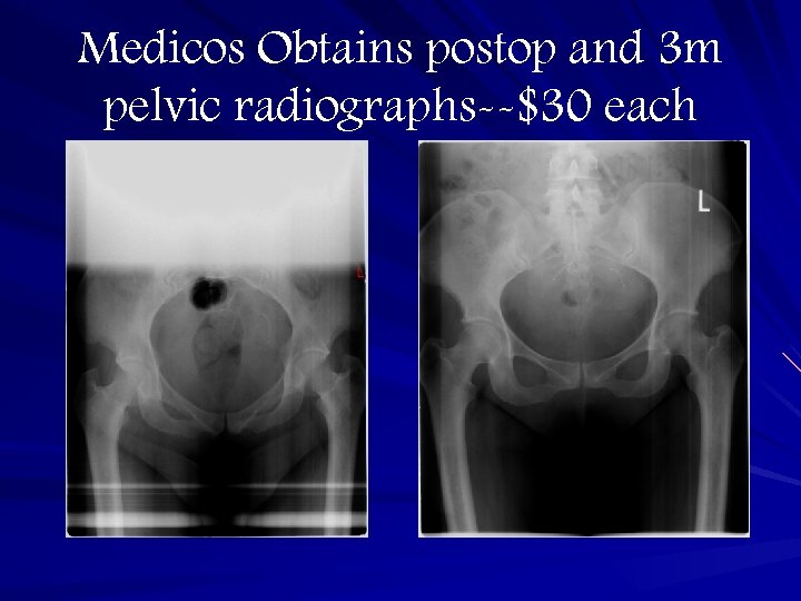Medicos Obtains postop and 3 m pelvic radiographs--$30 each 