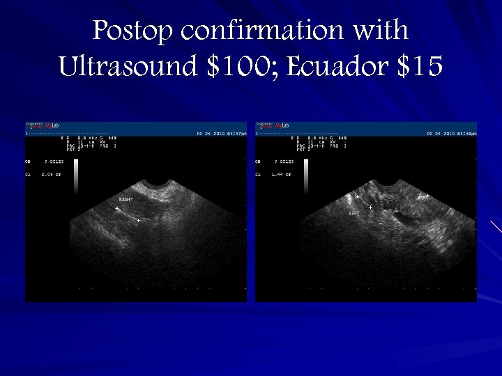 Postop confirmation with Ultrasound $100; Ecuador $15 