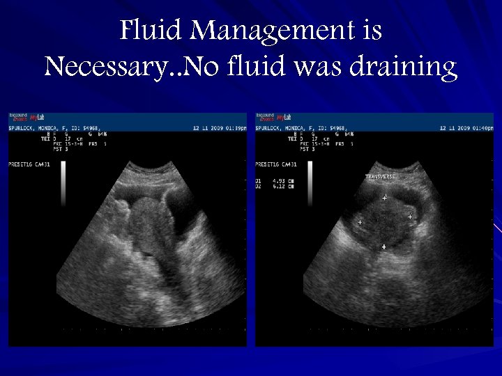 Fluid Management is Necessary. . No fluid was draining 