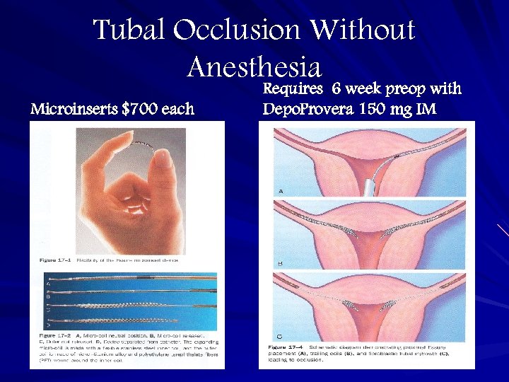 Tubal Occlusion Without Anesthesia Microinserts $700 each Requires 6 week preop with Depo. Provera