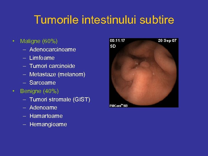Tumorile intestinului subtire • Maligne (60%) – Adenocarcinoame – Limfoame – Tumori carcinoide –