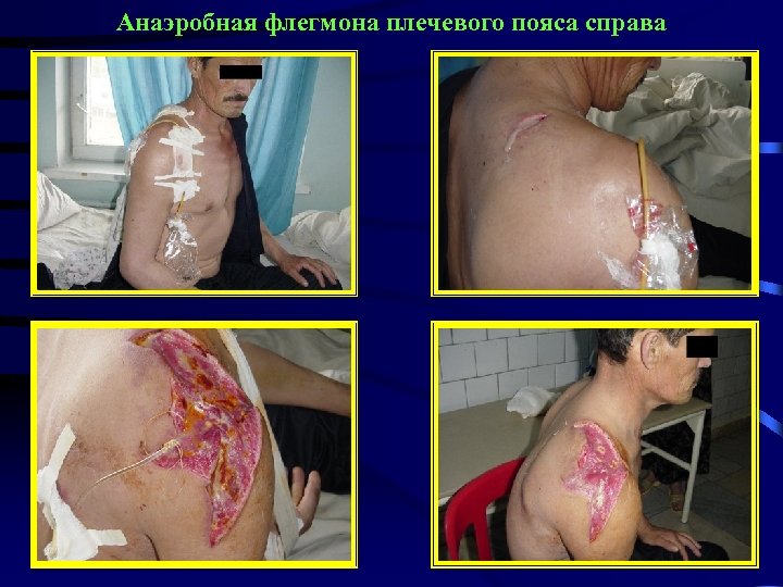 Анаэробная флегмона плечевого пояса справа 