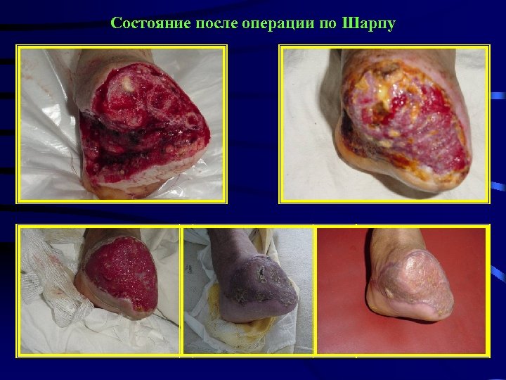 Состояние после операции по Шарпу 