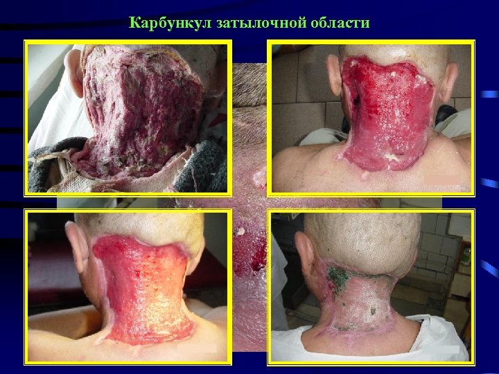 Карбункул затылочной области 