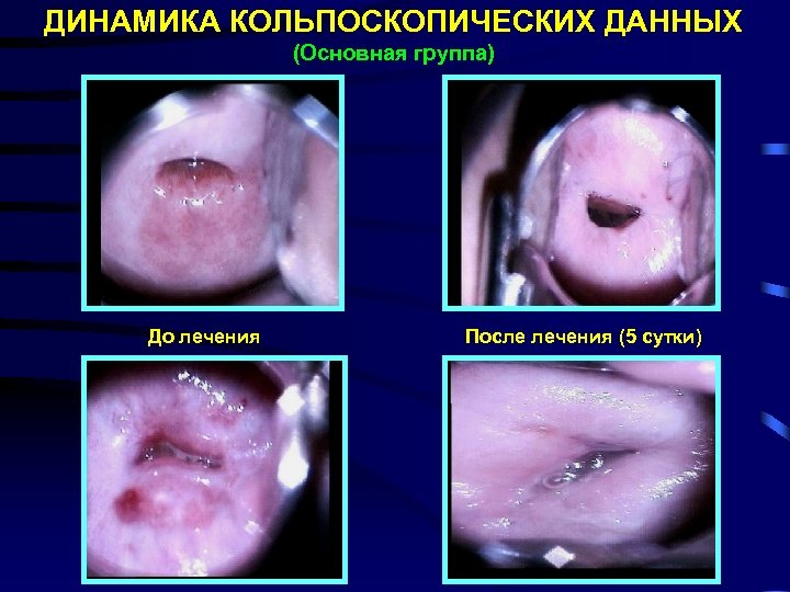 ДИНАМИКА КОЛЬПОСКОПИЧЕСКИХ ДАННЫХ (Основная группа) До лечения После лечения (5 сутки) 