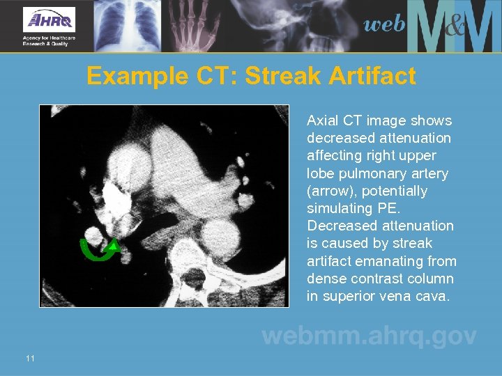 Example CT: Streak Artifact Axial CT image shows decreased attenuation affecting right upper lobe