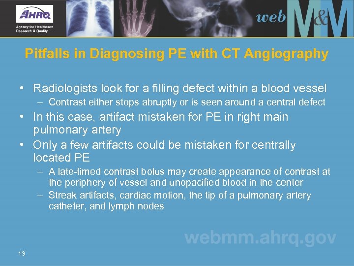 Pitfalls in Diagnosing PE with CT Angiography • Radiologists look for a filling defect