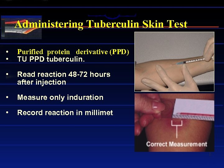 Administering Tuberculin Skin Test • • Purified protein derivative (PPD) TU PPD tuberculin. •