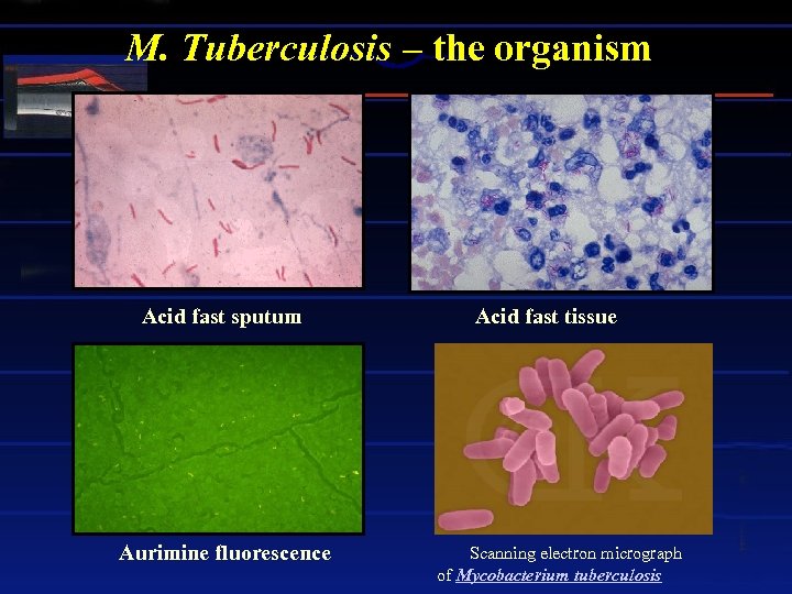M. Tuberculosis – the organism Acid fast sputum Aurimine fluorescence Acid fast tissue Scanning