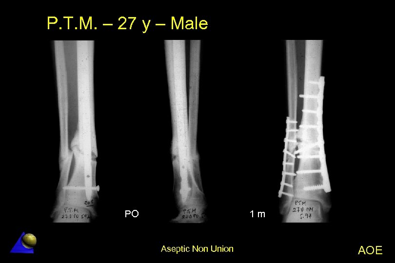 P. T. M. – 27 y – Male PO 1 m Aseptic Non Union