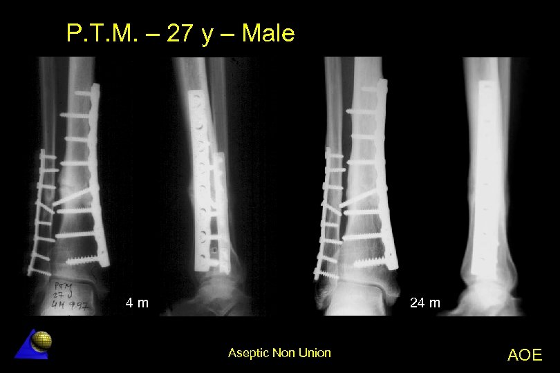 P. T. M. – 27 y – Male 4 m 24 m Aseptic Non