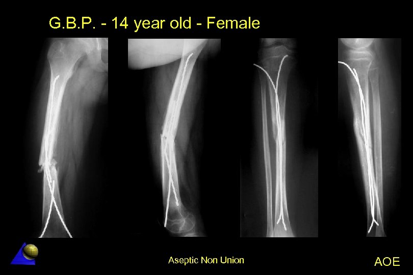 G. B. P. - 14 year old - Female Aseptic Non Union AOE 