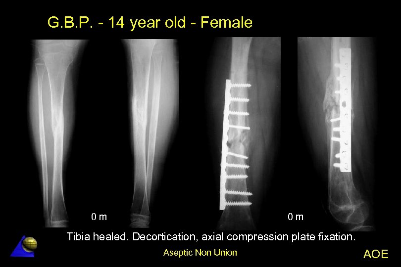 G. B. P. - 14 year old - Female 0 m 0 m Tibia