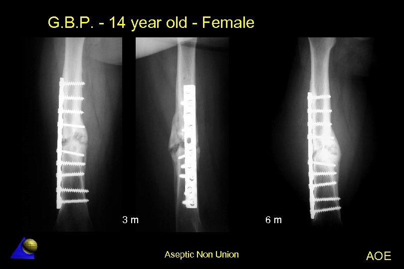 G. B. P. - 14 year old - Female 3 m 6 m Aseptic