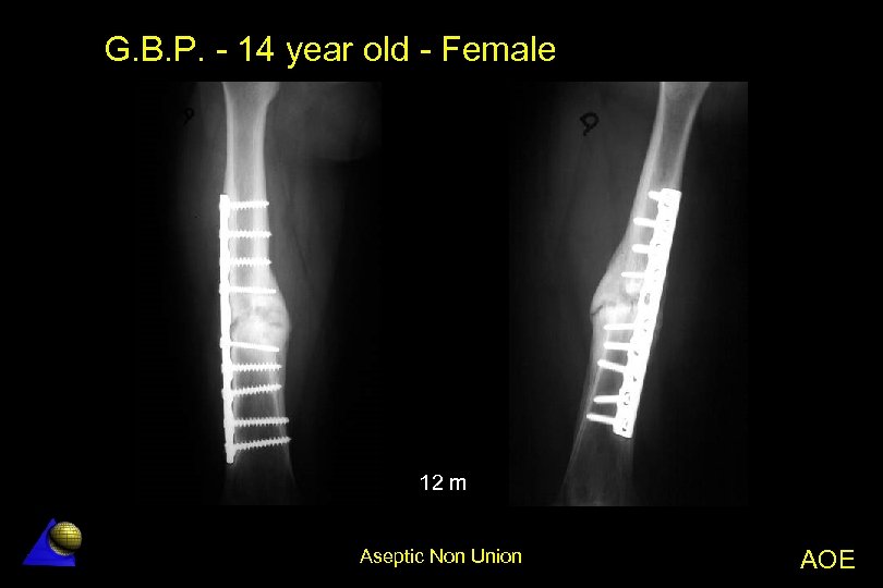 G. B. P. - 14 year old - Female 12 m Aseptic Non Union