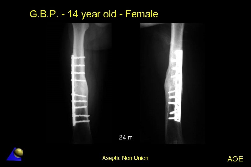 G. B. P. - 14 year old - Female 24 m Aseptic Non Union