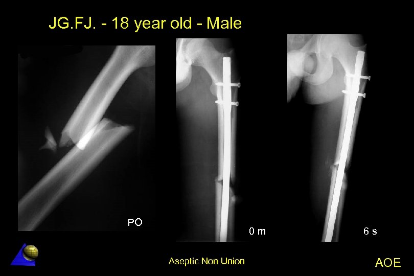 JG. FJ. - 18 year old - Male PO 0 m Aseptic Non Union