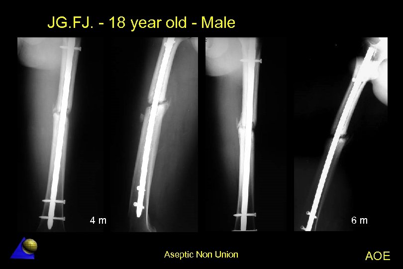 JG. FJ. - 18 year old - Male 4 m 6 m Aseptic Non