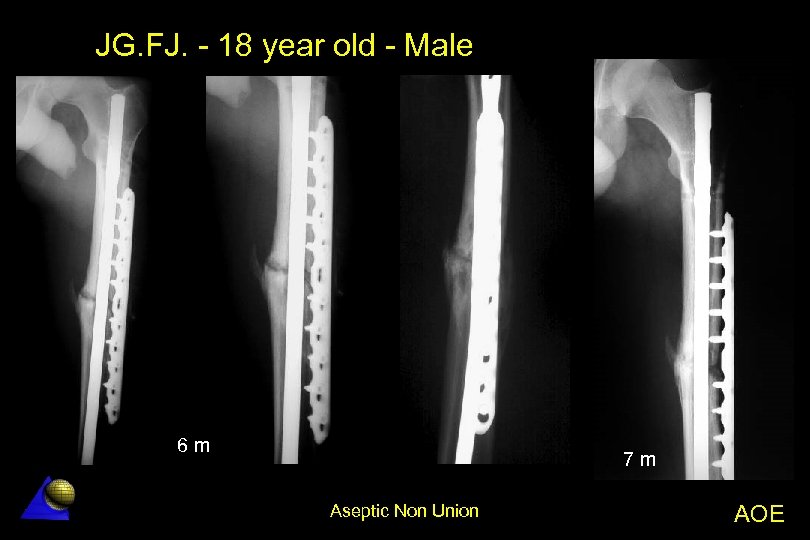 JG. FJ. - 18 year old - Male 6 m 7 m Aseptic Non