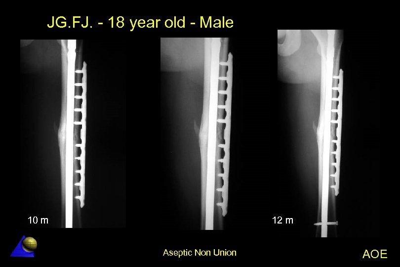 JG. FJ. - 18 year old - Male 10 m 12 m Aseptic Non