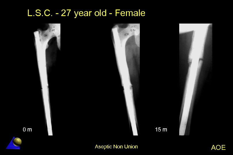 L. S. C. - 27 year old - Female 0 m 15 m Aseptic